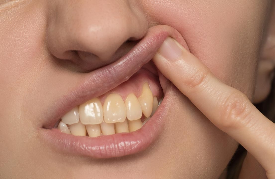 Gum Disease Dental Condition