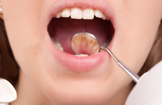 Dental-Decay-Treatment-Hoppers-Crossing