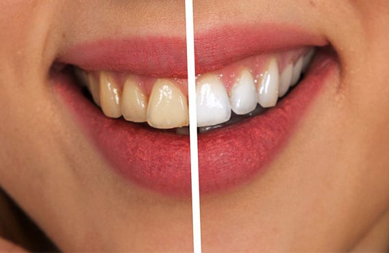 Teeth Whitening Treatment Hoppers Crossing